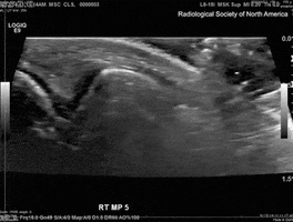 ultrasound cracking GIF by University of California