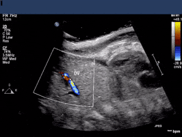 plabarta aritificial womb GIF