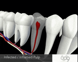root canals GIF