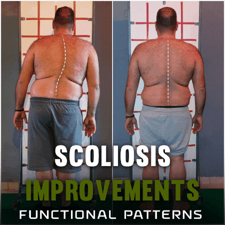 Scoliosis GIF by functionalpatterns