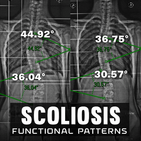 Scoliosis GIF by functionalpatterns