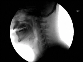 swallowing x ray GIF