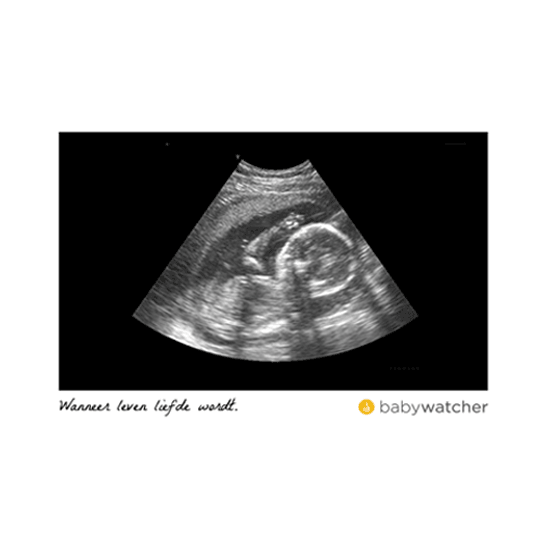 Echo Ultrasound Sticker by Babywatcher for iOS & Android GIPHY
