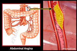 what is abdominal angina GIF by ePainAssist