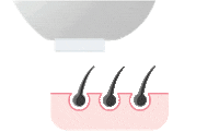 Hair Laser Sticker by Quanta System