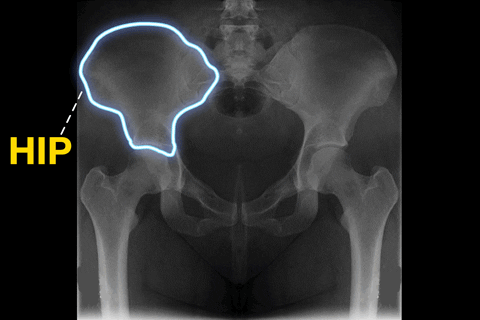 Digital art gif. The hip bones of a human torso X ray light up one at a time. Yellow text, "Hip, hip, Hooray!"