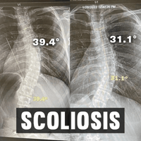 Scoliosis GIF by functionalpatterns