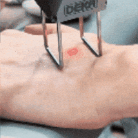 DermaproLaser skincare manos piel derma GIF