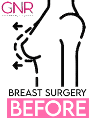 Bbl Breast Sticker by GNR Esthetics