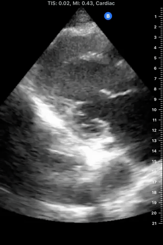 afib reduced ef GIF