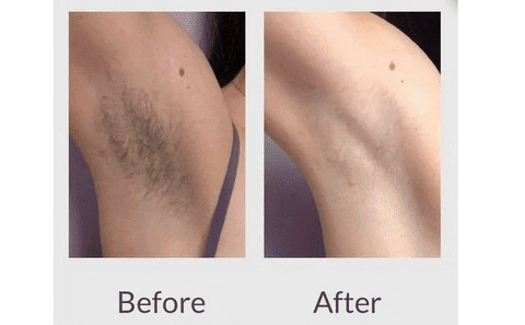 Anatomylaborg giphyupload laser hair removal hair removal GIF