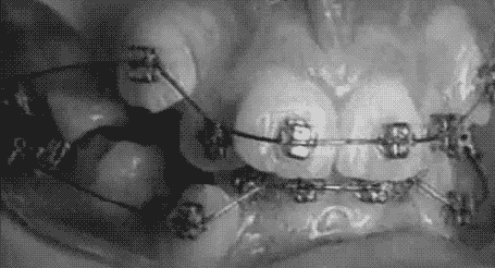 braces effectiveness GIF