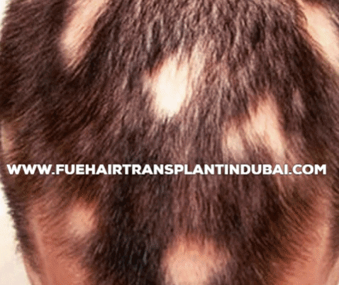 abiaamir giphygifmaker hair loss alopecia GIF