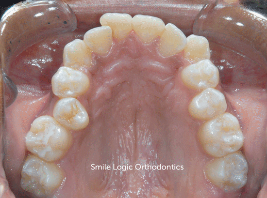teeth GIF