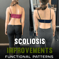 Scoliosis GIF by functionalpatterns