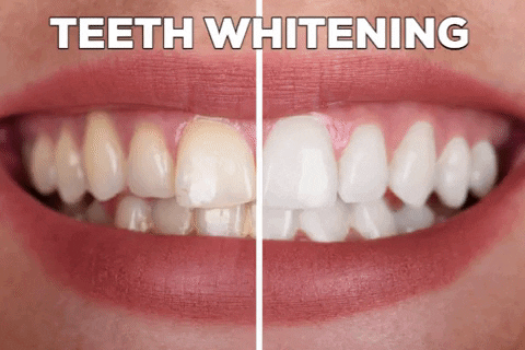 atlantisdentalcare giphygifmaker teeth whitening dental service GIF
