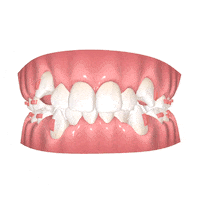 SmarteeCol sonrisa transparente dientes alineador Sticker