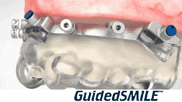 GuidedSMILE GIF